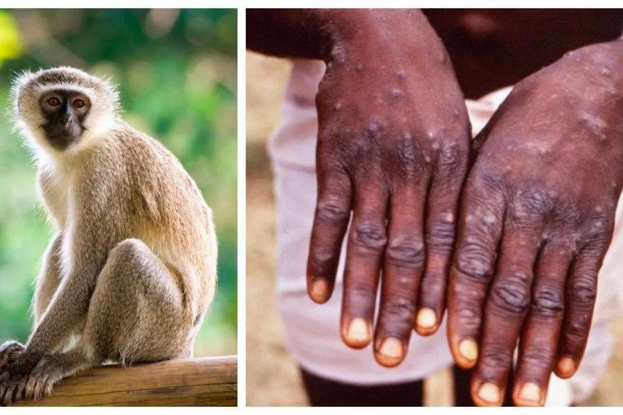 Мавпяча віспа: усе, що треба знати про хворобу сьогодні