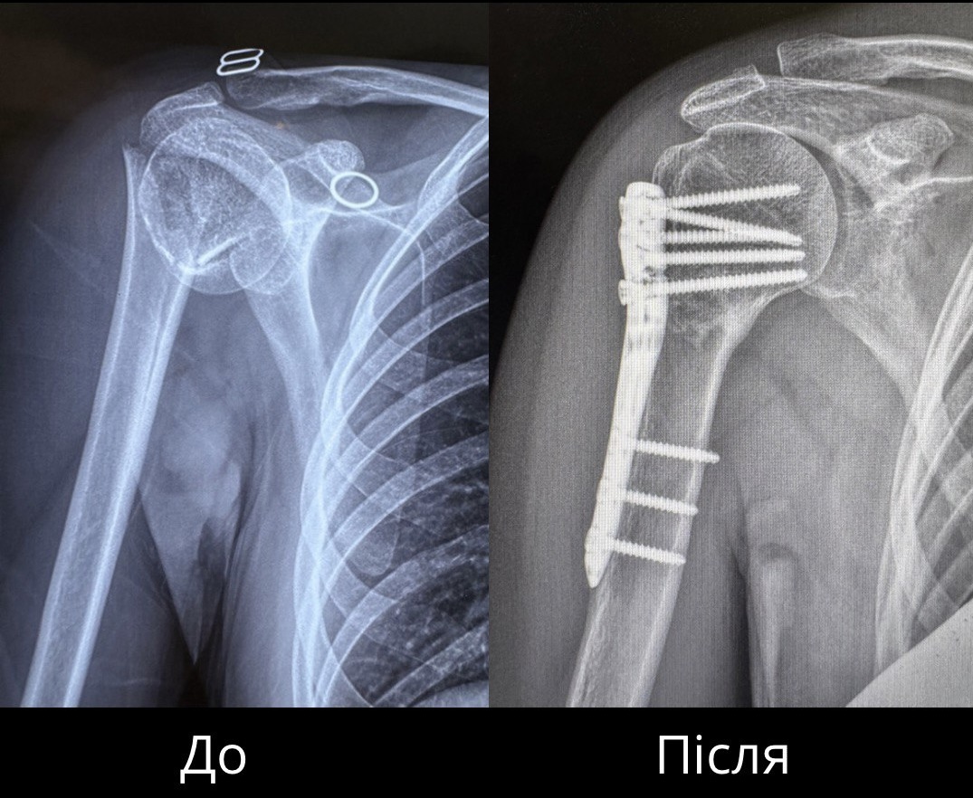 Рентгенографія плечового суглоба: перелом хірургічної шийки плечової кістки. До та після операції